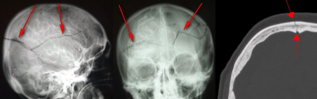 Ảnh 2 của Basilar Skull Fracture
